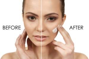 Acne treatment amsterdam