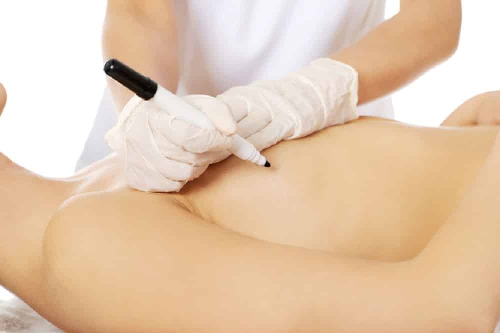 Cryotherapie-mannenborsten-cryo21-amsterdam-cryolipolyse- bet-bevriezen