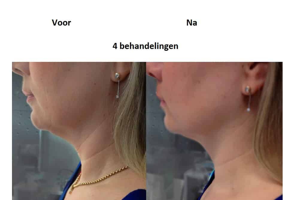 Vet bevriezen onderkin 2 Cryotherapie-onderkin