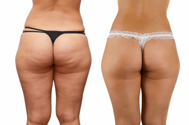 Cellulite behandeling amsterdam voor en na