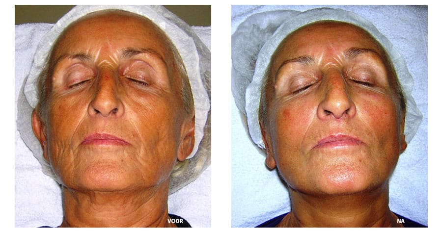 Bio Skinlight Amsterdam 1 Bio Skinlight Amsterdam 1