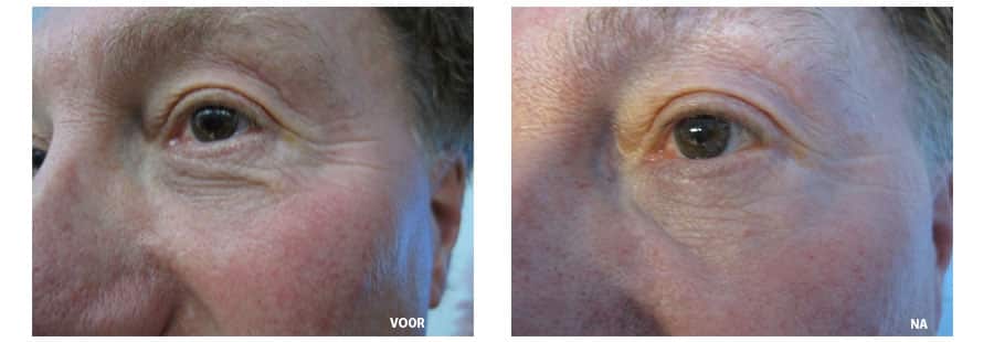 Bio Skinlight Amsterdam 2 Bio Skinlight Amsterdam 2