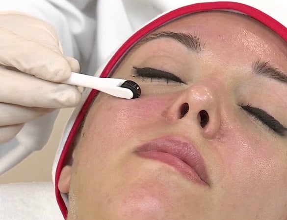 Dermapen behandeling Amsterdam 3 Microneedling-oog-behandeling