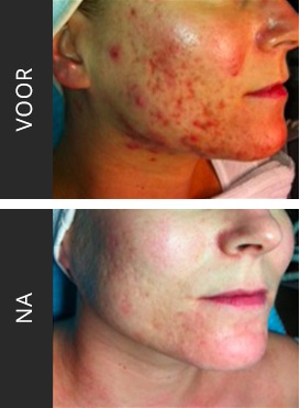 Rosacea-couperose-resultaten