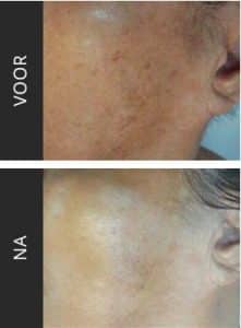 pigment spots treatment