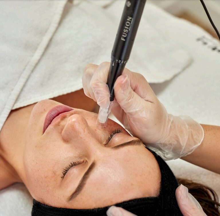 Microneedling Amsterdam 3 Microneedling-behandeling-amsterdam
