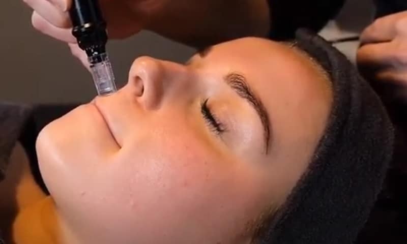 Dermapen behandeling Amsterdam 3 dermapen behandeling