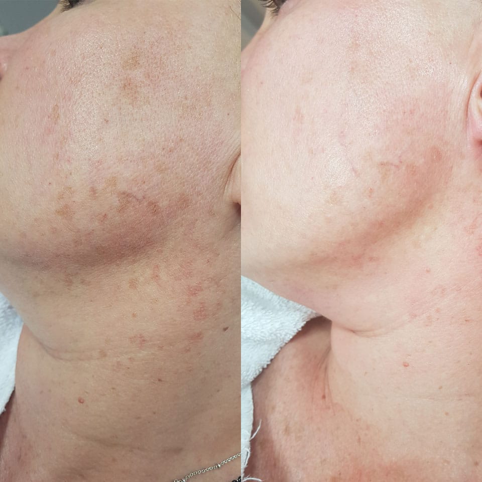 Remove pigment spots amsterdam