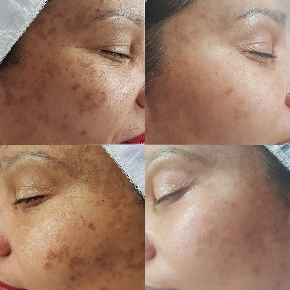 Remove pigment spots