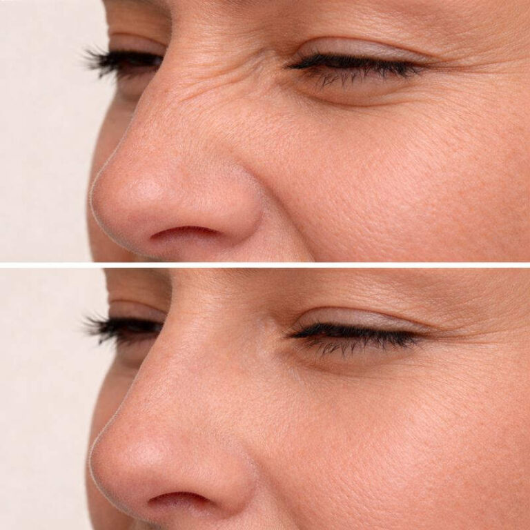 Voor en na weergave van bunny lines langs de neus, waarbij de lijnen bij expressie zichtbaar zijn verminderd, toegepast in Amsterdam.