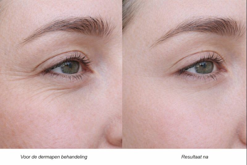 Natuurlijk resultaat na dermapen behandeling.